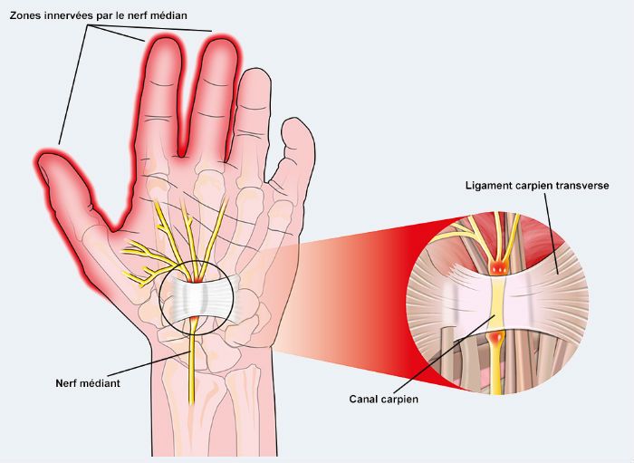 syndrome_canal_carpien-compressor
